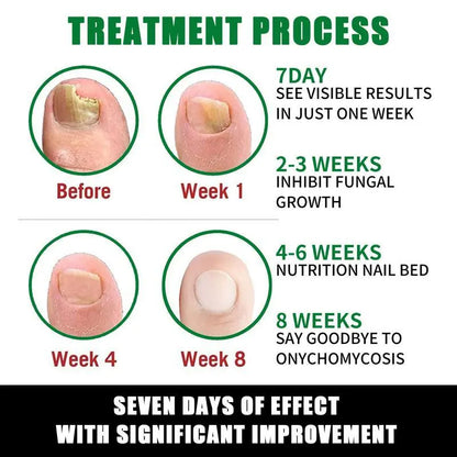 Suero Revitalizante de Uñas Umex® 7 Días