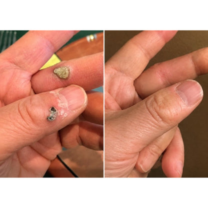 2-in-1 Microneedle & Hydrocolloid Patch 🌿 Invisible Face & Body Patches for Raised Moles, Acne, Flat Warts & Skin Tags - Helps Improve the Appearance of Wrinkles, Scars & Blemishes